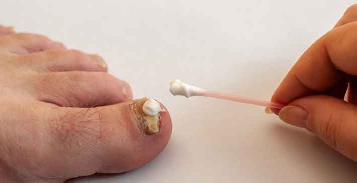 You are currently viewing Toenail Fungus: Prevent And Cure it Cheaply